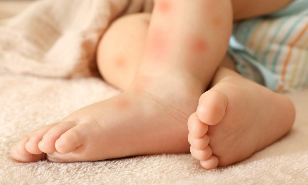 alergias en la piel de los bebés
