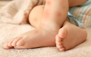 alergias en la piel de los bebés