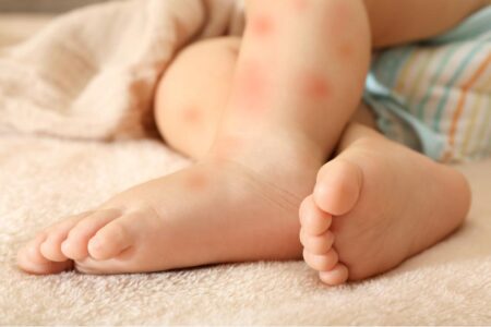 alergias en la piel de los bebés