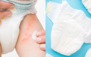 dermatitis de pañal