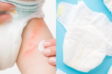 dermatitis de pañal
