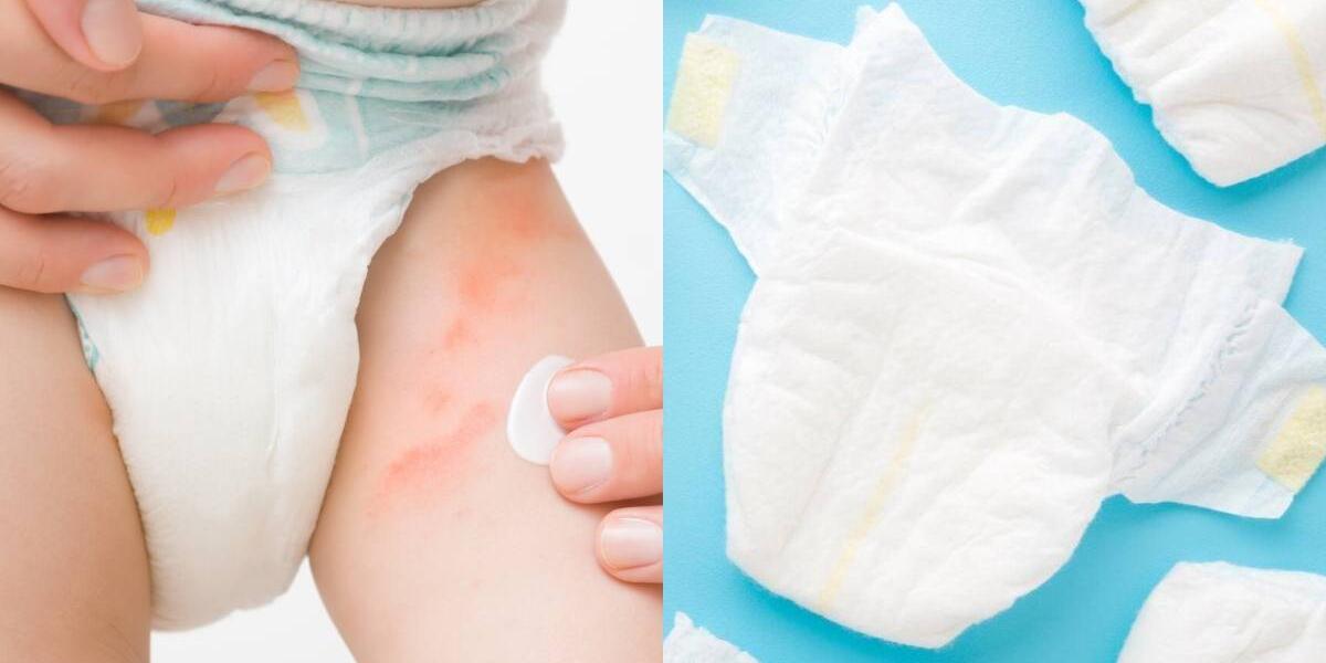 dermatitis de pañal