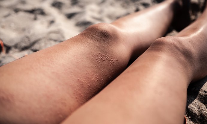 irritación por calor